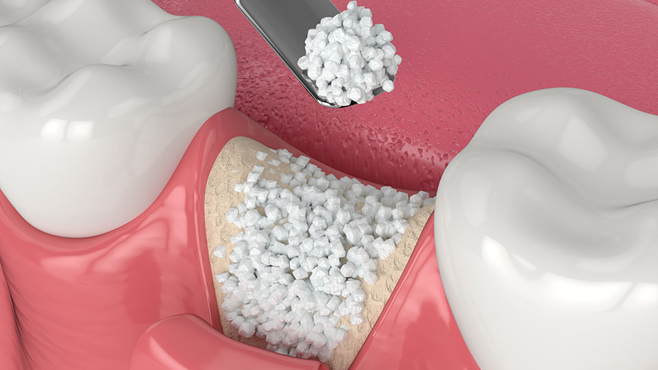 Bone Grafting Dentists Greater Orlando Florida